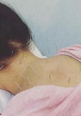 哪些明星做过针灸